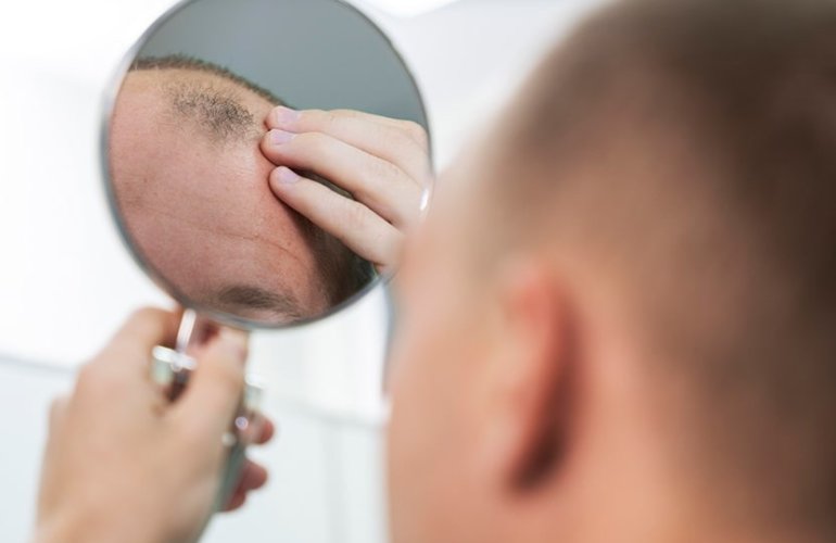 Saç Ekimi İçin Doğru Klinik Nasıl Seçilir? Nelere Dikkat Etmelisiniz?